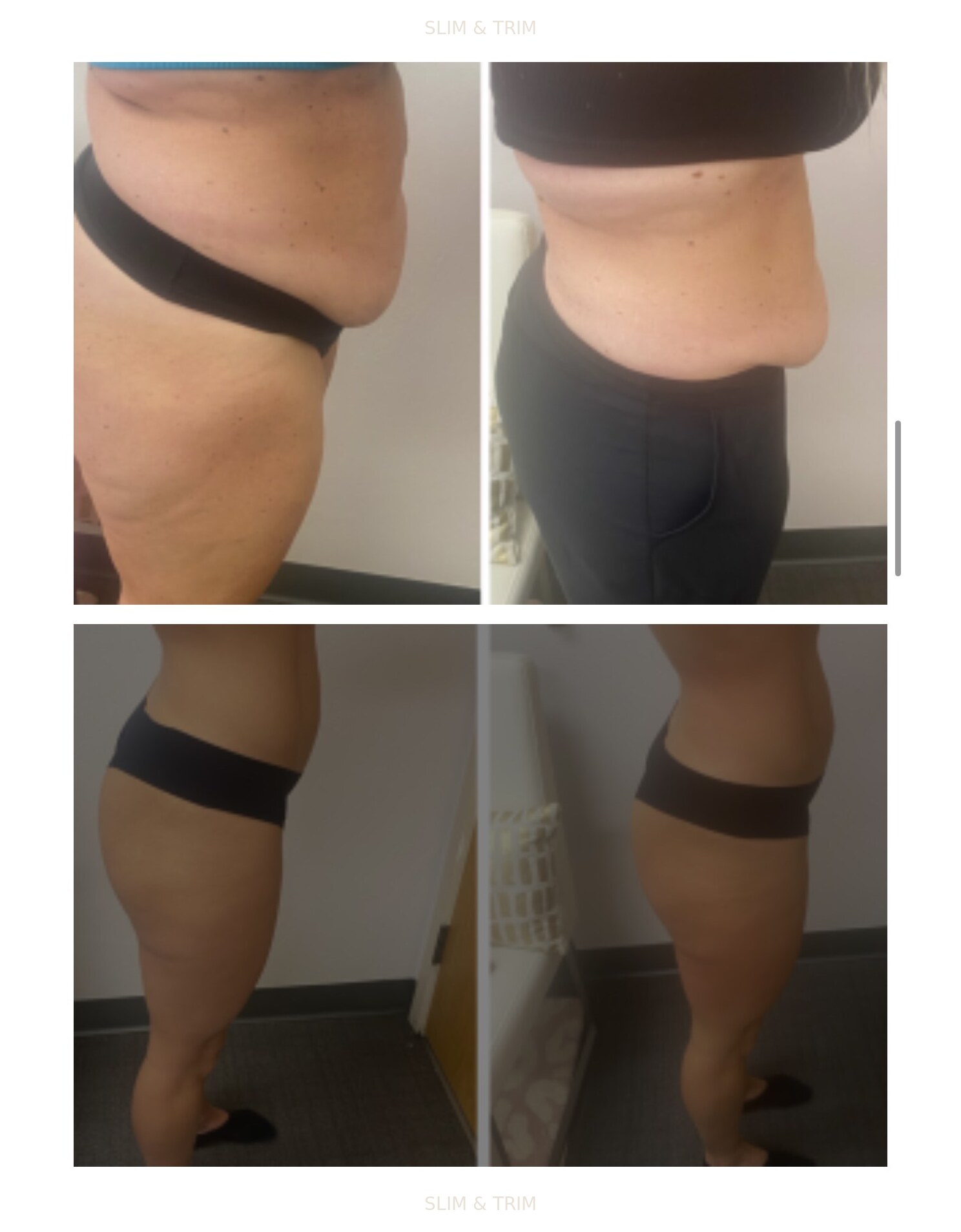 Client-provided before-and-after photo collage showing side waist and leg views