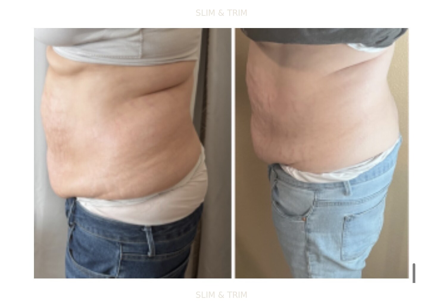 Client-provided before-and-after photo collage showing a side abdomen view