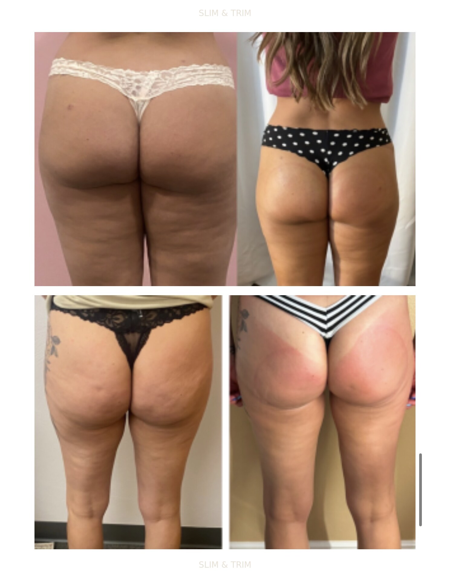 Client-provided before-and-after photo collage showing thigh and leg views