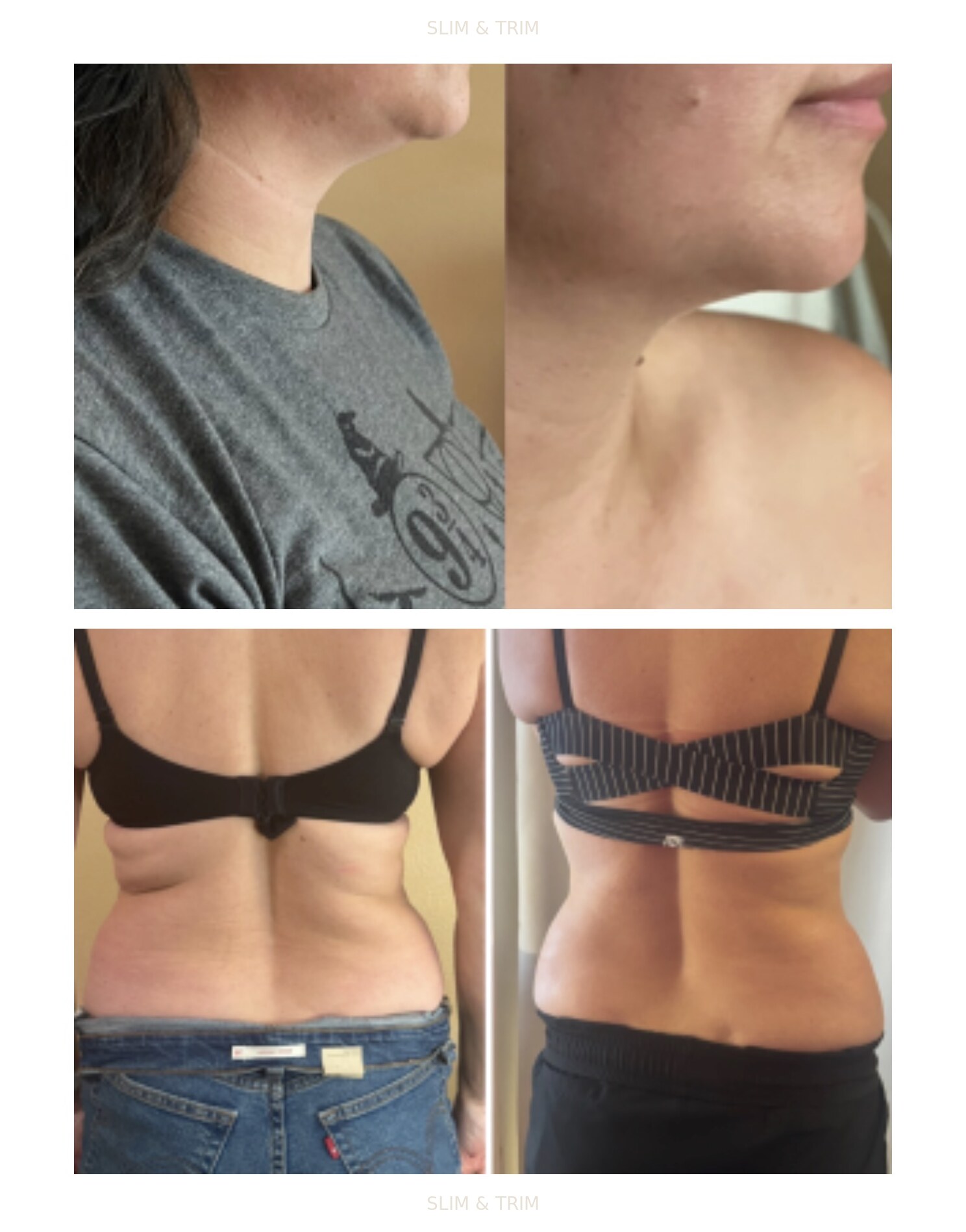 Client-provided before-and-after photo collage showing chin, waist, and back views
